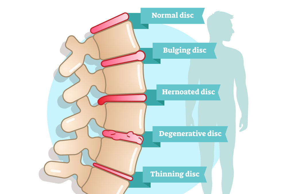 What Is Chronic Degenerative Disease