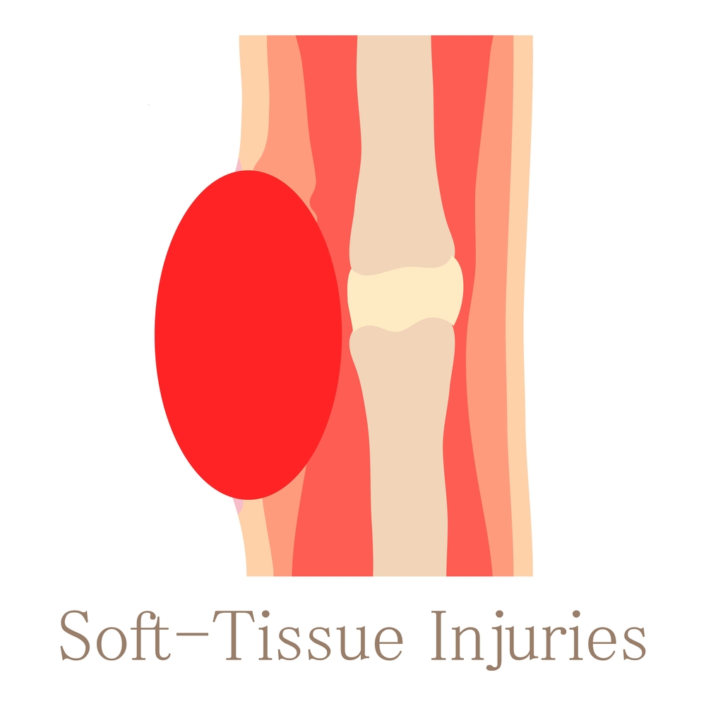 What Is a Soft Tissue Injury?